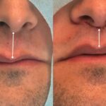 Lip Lift amplia opções de rejuvenescimento sem volume